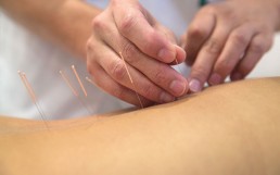 Akupunktur am Rücken